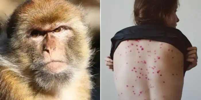 Ya son 6 los infectados con viruela del mono en Argentina