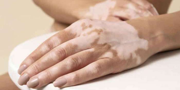 Casi un 2% de la población mundial tiene vitiligo