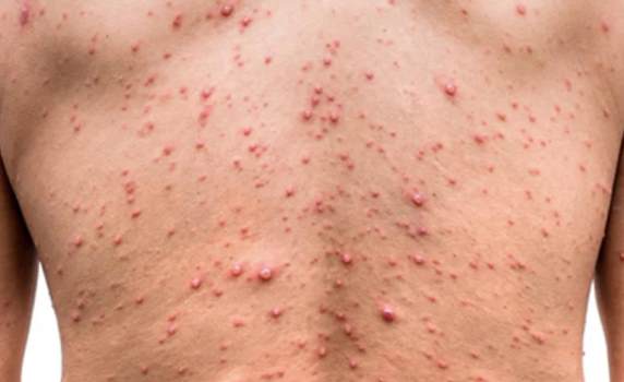 Detectaron el primer caso sospechoso de viruela del mono en la Argentina